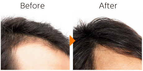 毛髪再生療法（頭皮育毛・薄毛治療）は、お顔全体のリフトアップにも効果あり PRPによる毛髪再生療法は、男性・女性に関わらず発毛・育毛・薄毛でお悩み