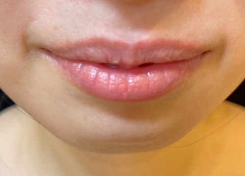 唇の肌再生ビフォー写真