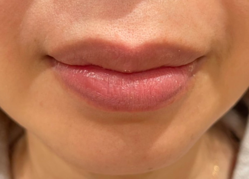唇の肌再生アフター写真