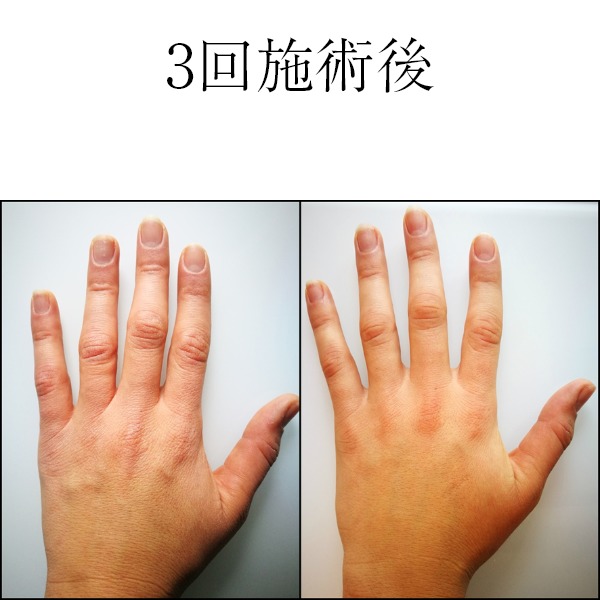 ミラノリピール3回施術後手指のイメージ