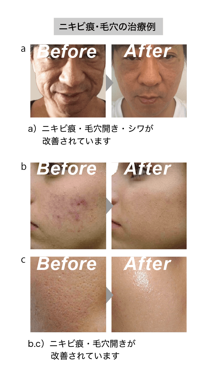 銀座 美容皮膚科で幹細胞治療を 口コミをチェック ニキビやニキビ痕の種類について フォーシーズンズ美容皮膚科クリニック