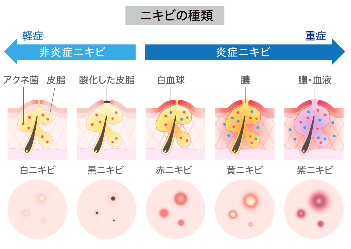 ニキビ跡 クレーター ニキビ痕 色素沈着 フォーシーズンズ美容皮膚科クリニック東京竹芝院 東京 港区