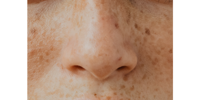 肌再生、シミ・そばかすの種類、鼻の雀卵斑（じゃくらんはん）