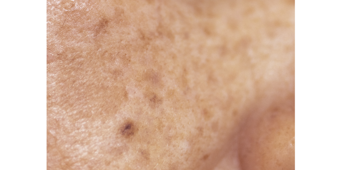 肌再生、シミ・そばかすの種類、頬の雀卵斑（じゃくらんはん）
