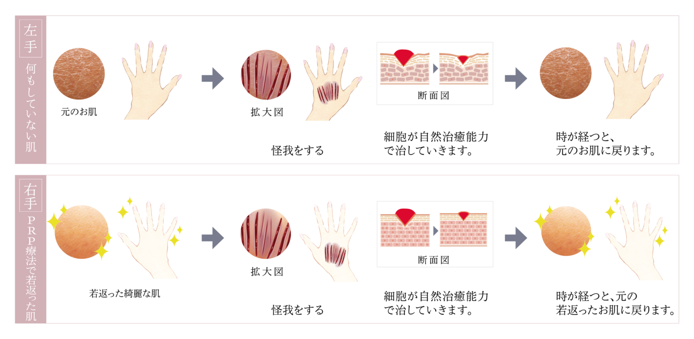 HP幹細胞＿手の図-prp