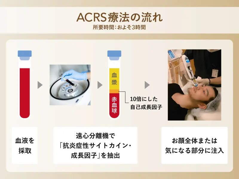 ACRS療法の流れ