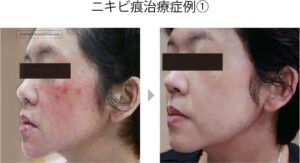 【東京】ニキビ痕治療はフォーシーズンズ美容皮膚科