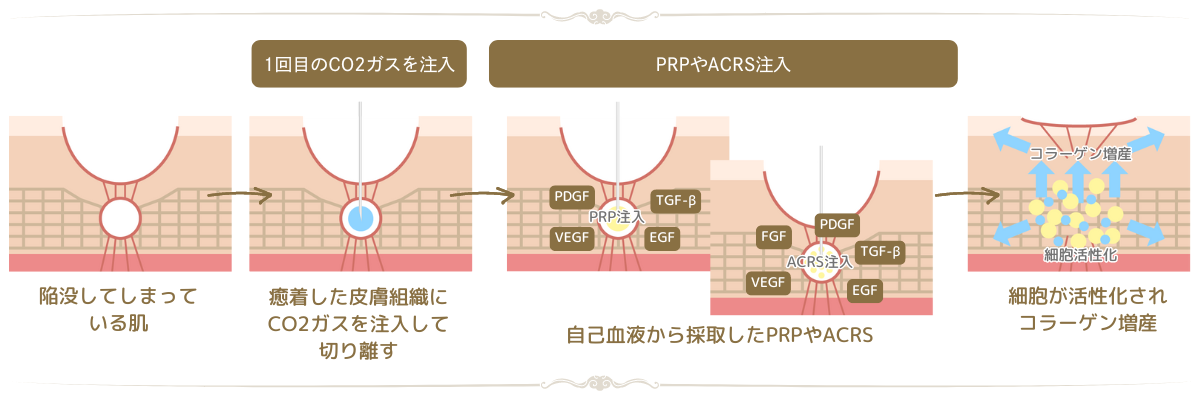 PRP肌再生療法・ACRS療法との併用で肌再生へ