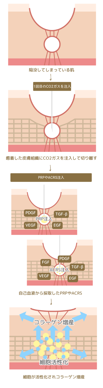 PRP肌再生療法・ACRS療法との併用で肌再生へ