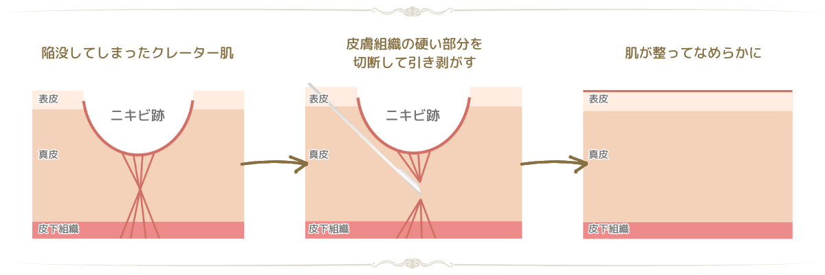 サブシジョンとは