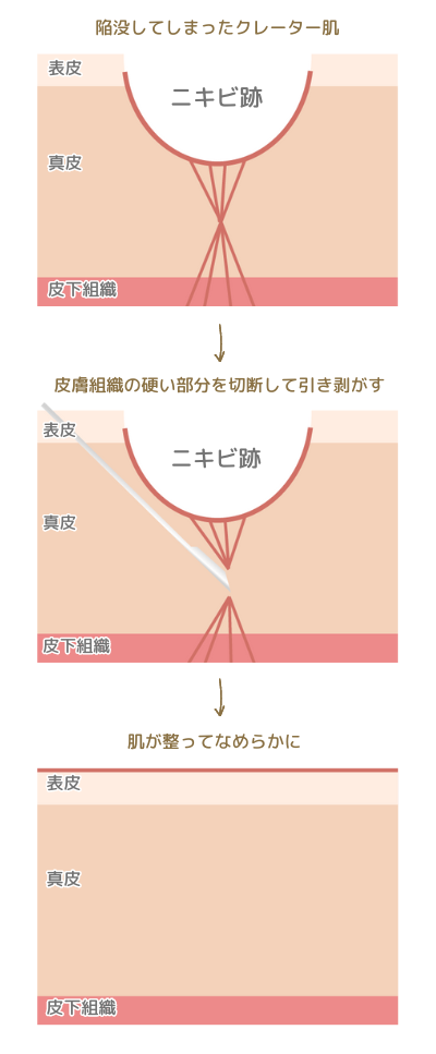 サブシジョンとは