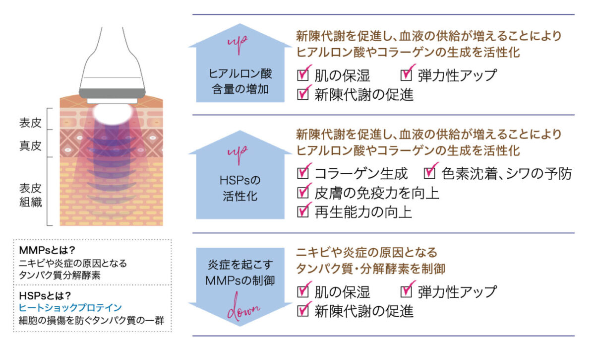 LDM-MED 高密度超音波治療とは