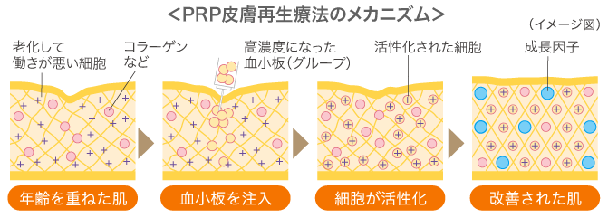 PRP皮膚再生療法とは