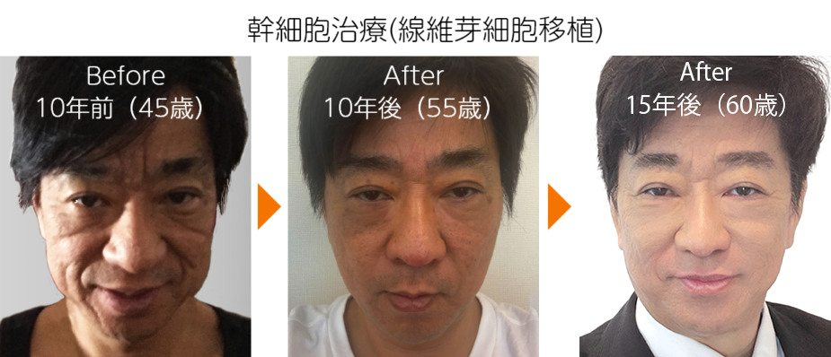 before after